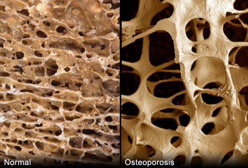 webmd rm photo of porous bones என்புருக்கி நோயும் அதனை தவிர்ப்பதற்கான வழிகளும்-Dr பீற்றர் குருசுமுத்து (MBBS, FRACP)