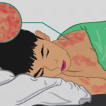 இலங்கையில் மீண்டும் தலைதூக்கியுள்ள தட்டம்மை நோய்!