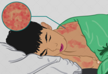 இலங்கையில் மீண்டும் தலைதூக்கியுள்ள தட்டம்மை நோய்!